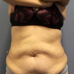 Abdominoplasty Before & After Patient #3854