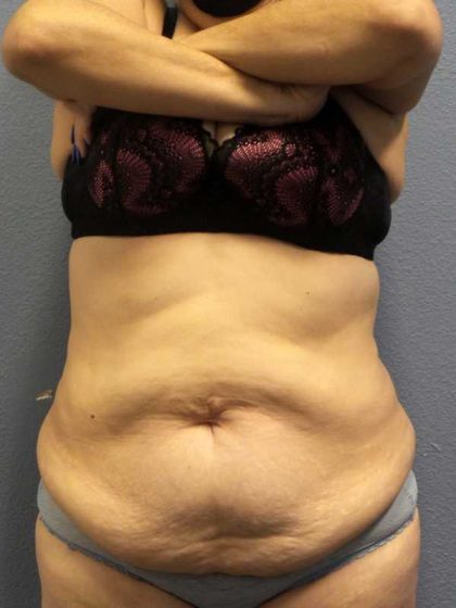High BMI (Larger Patients) Surgery Before & After Patient #10466