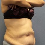 High BMI (Larger Patients) Surgery Before & After Patient #10466