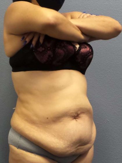Abdominoplasty Before & After Patient #3854