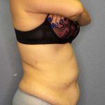 Abdominoplasty Before & After Patient #3854