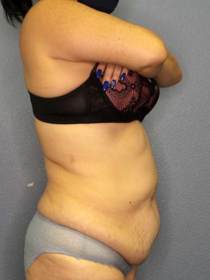 High BMI (Larger Patients) Surgery Before & After Patient #10466