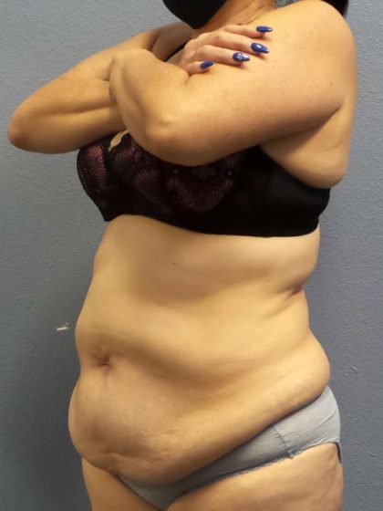 Abdominoplasty Before & After Patient #3854