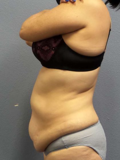 Abdominoplasty Before & After Patient #3854