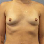 Breast Augmentation Before & After Patient #6687