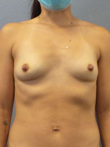Breast Augmentation Before & After Patient #6687