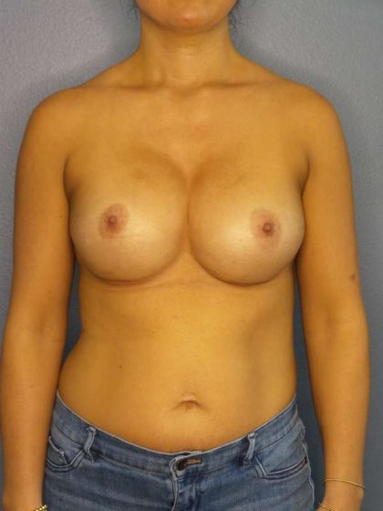 Breast Augmentation Revision (Breast Enlargement Repair) Before & After Patient #7163