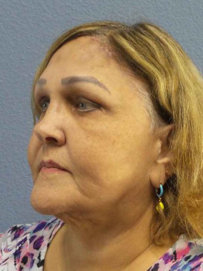 Periorbital Before & After Patient #8637