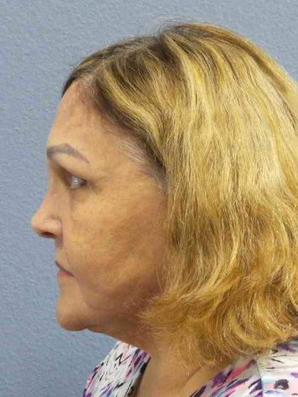 Periorbital Before & After Patient #8637