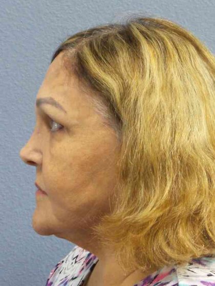 Periorbital Before & After Patient #8637