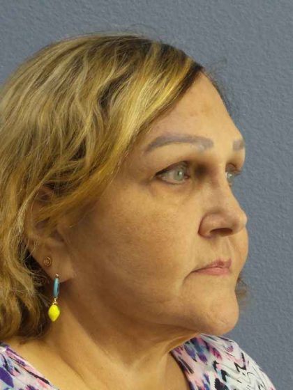 Periorbital Before & After Patient #8637