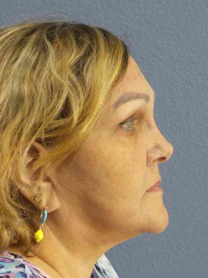 Periorbital Before & After Patient #8637