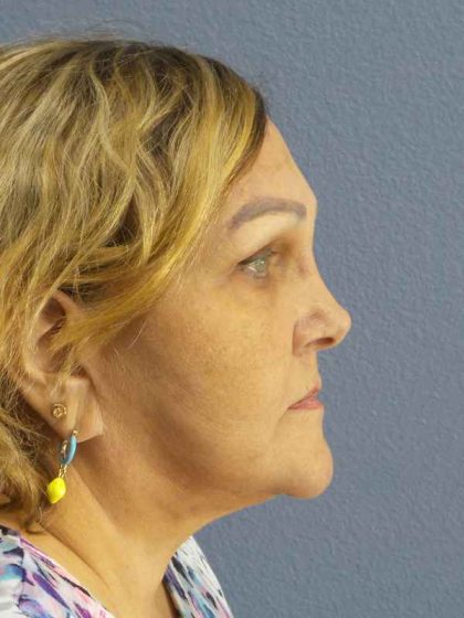 Periorbital Before & After Patient #8637
