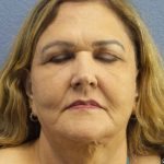 Periorbital Before & After Patient #8637