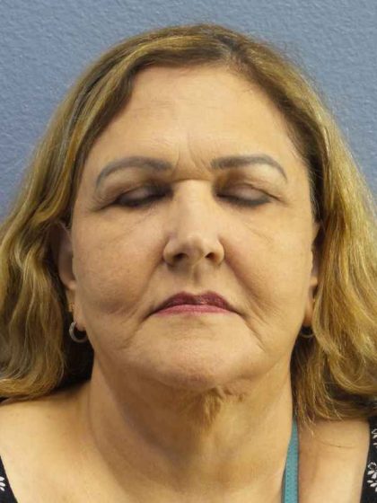 Periorbital Before & After Patient #8637