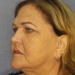 Periorbital Before & After Patient #8637