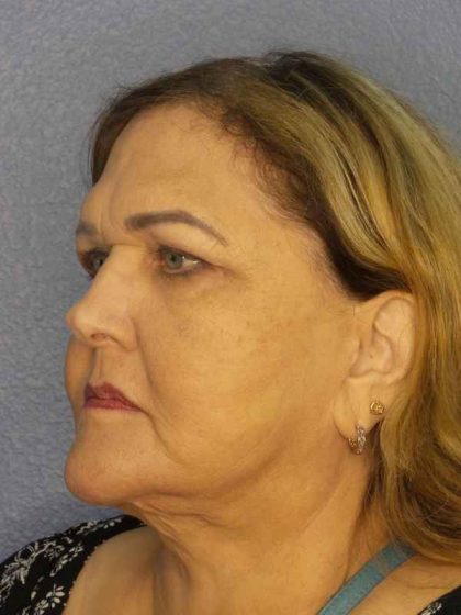 Periorbital Before & After Patient #8637