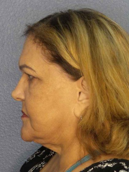 Periorbital Before & After Patient #8637