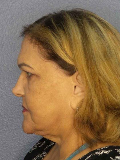 Periorbital Before & After Patient #8637