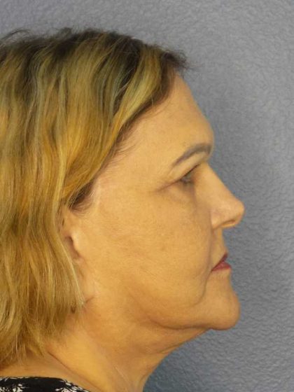 Periorbital Before & After Patient #8637