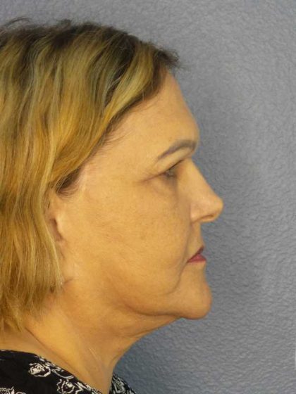 Periorbital Before & After Patient #8637