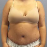 Abdominoplasty Before & After Patient #3305