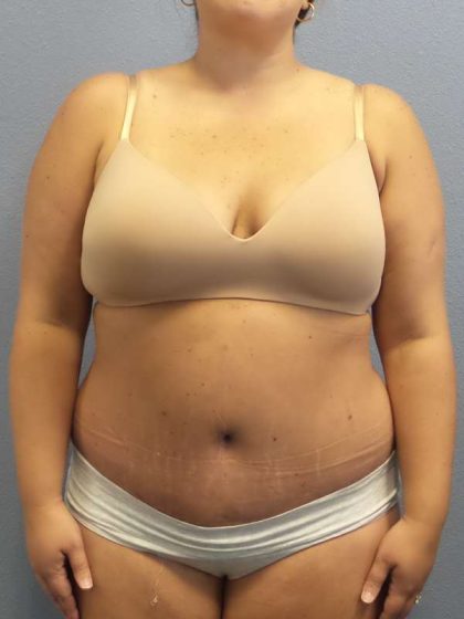 Abdominoplasty Before & After Patient #3305