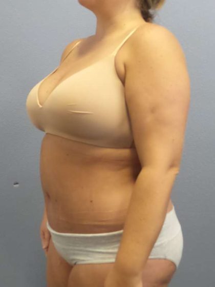 Abdominoplasty Before & After Patient #3305