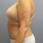 Abdominoplasty Before & After Patient #3305