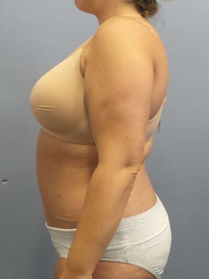 Abdominoplasty Before & After Patient #3305