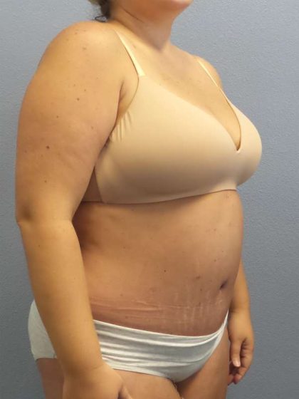 Abdominoplasty Before & After Patient #3305