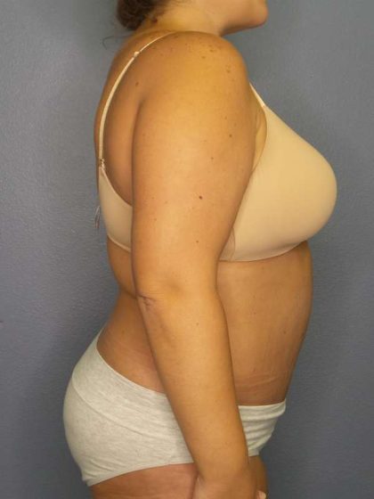 Abdominoplasty Before & After Patient #3305