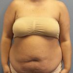Abdominoplasty Before & After Patient #3305