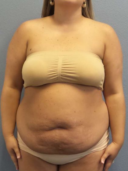 Abdominoplasty Before & After Patient #3305