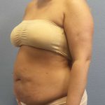 Abdominoplasty Before & After Patient #3305