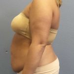 Abdominoplasty Before & After Patient #3305