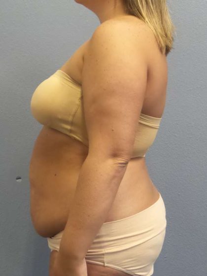 Abdominoplasty Before & After Patient #3305