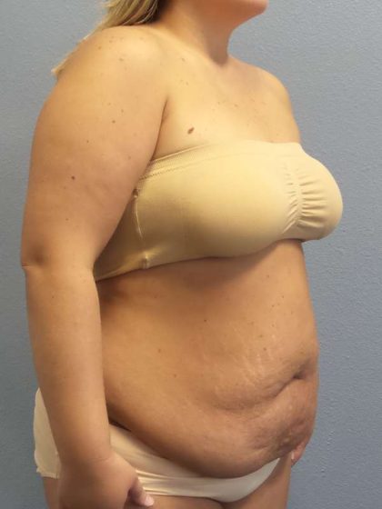 Abdominoplasty Before & After Patient #3305