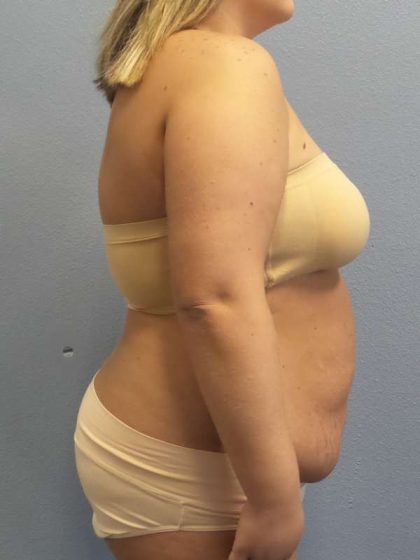 Abdominoplasty Before & After Patient #3305
