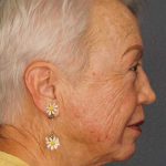 Resurfacing Before & After Patient #8863