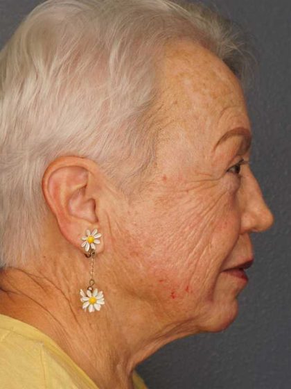 Resurfacing Before & After Patient #8863