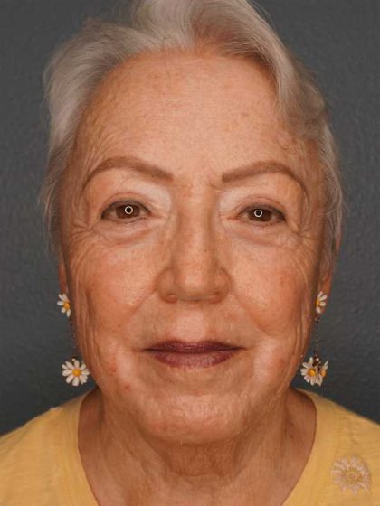 Resurfacing Before & After Patient #8863