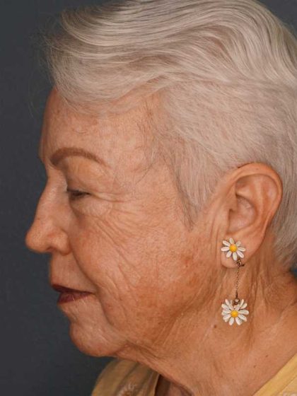 Resurfacing Before & After Patient #8863