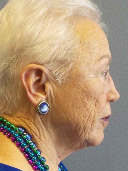 Resurfacing Before & After Patient #8863