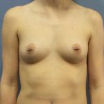 Breast Augmentation Before & After Patient #6427