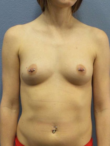 Breast Augmentation Before & After Patient #6427