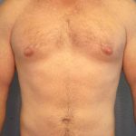 Male Liposuction Before & After Patient #7731