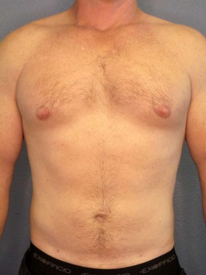 Male Liposuction Before & After Patient #7731