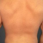 Male Liposuction Before & After Patient #7731