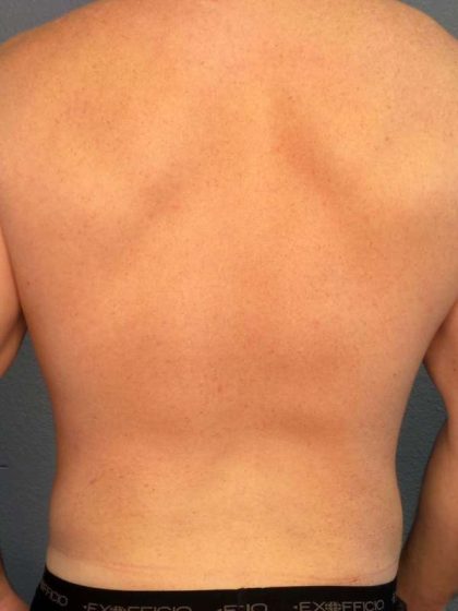 Male Liposuction Before & After Patient #7731